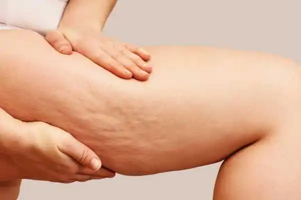 Image of woman showing leg with cellulite Spring Vale