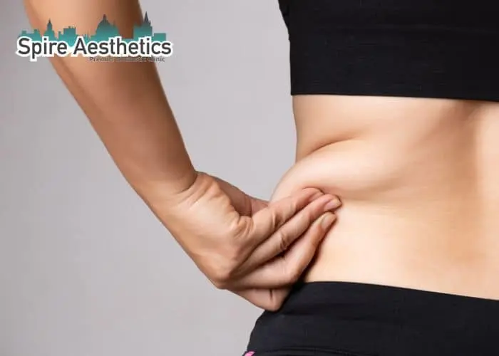 Image of woman pinching fat on their hips Spring Vale. Fat Freezing treatment