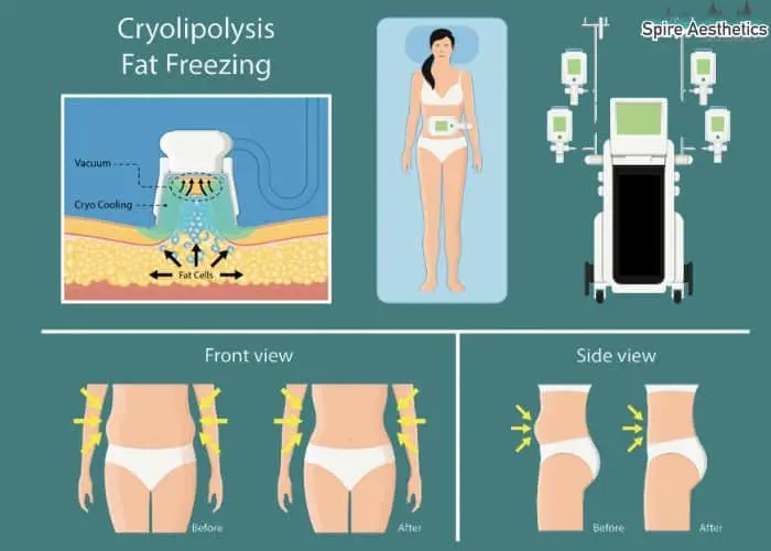 Fat freezing treatment Spring Vale benefits for competitions to remove stubborn fat deposits.