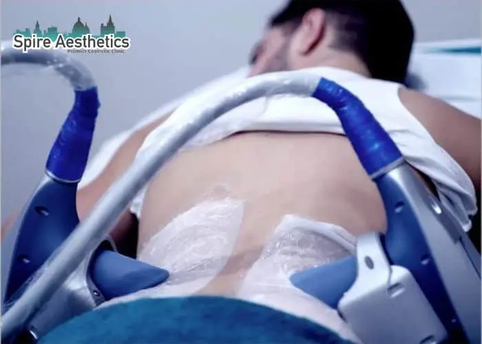 Man having fat freezing treatment done on love handles before a competitions Spring Vale to create a sculpted look.