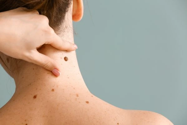 skin blemish removal Spring Vale treatment