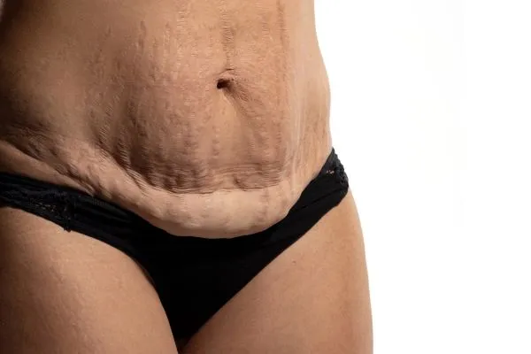 Image of womans stomach after weight loss injections Spring Vale showing saggy skin